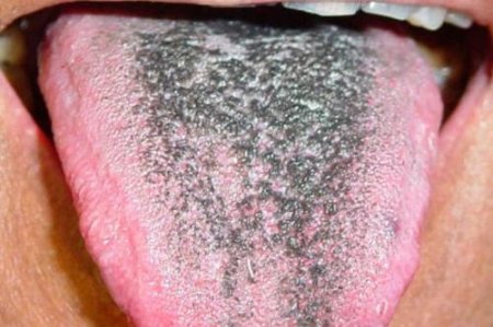 В США зарегистрировали болезнь «черного волосатого языка»