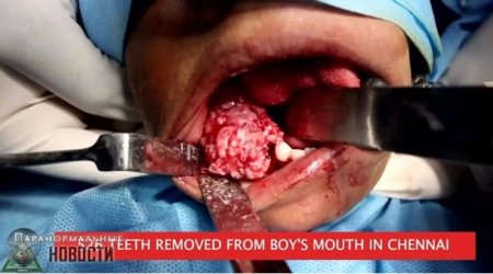 Врачи удалили у ребёнка более 500 зубов (ФОТО, ВИДЕО)